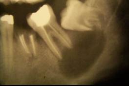 Fig 3 RX periapical centrada a nivel de 3.7