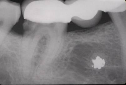 Fig. 1 RX periapical centrada en 4.6-4.7. . (RX DIAGNOSTICO)