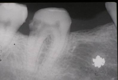 Fig. 2 Puente levantado