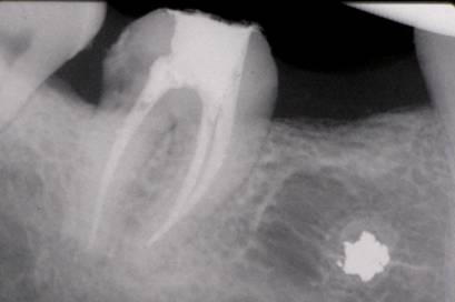 Fig. 3 Biopulpectomia total terminada (rx de obturación definitiva. Post-operatorio inmediato)