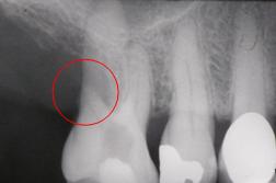 Fig.1 : RX diagnostico donde se aprecia la radicectomia