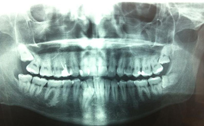 cementoblastoma-radiografia-1.jpg