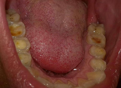 erosion-dental-1.jpg