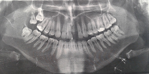 2-molar-ectopico.jpg