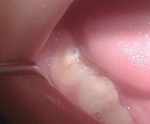 HIPOMINERALIZACION-INCISIVO-MOLAR-1.jpg