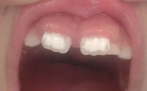 HIPOMINERALIZACION-INCISIVO-MOLAR-2.jpg