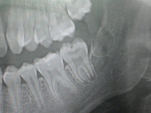 varicela-molar-2.jpg
