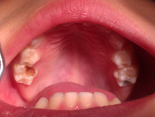 caries-biberon.jpg