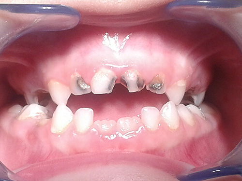 DEGLUCION-ATIPICA-MALOCLUSION.jpg