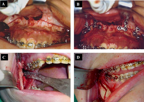 Prognatismo Mandibular o Clase 3 » Cirugía Ortognática - Instituto